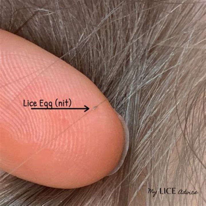 Are lice eggs bigger than dandruff?