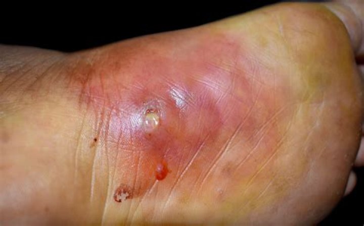 Can a bee sting through blue jeans?