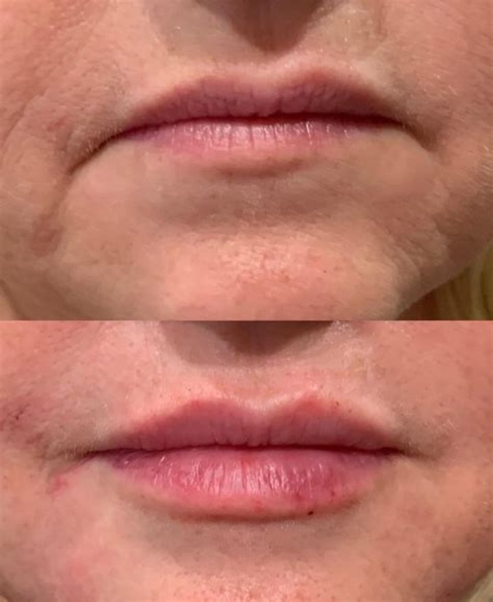 Can a downturned mouth be fixed?