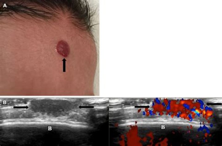 Can a hemangioma cause death?