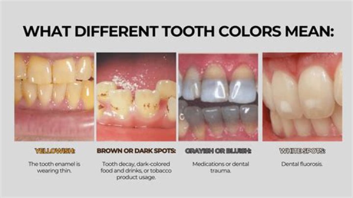 Can a tooth turn grey?