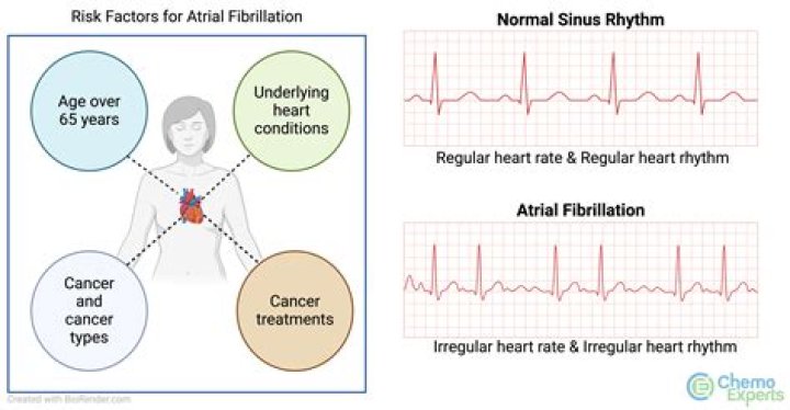 Can AFib affect vision?