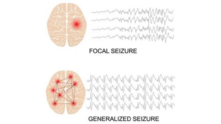 Can car rides trigger seizures?