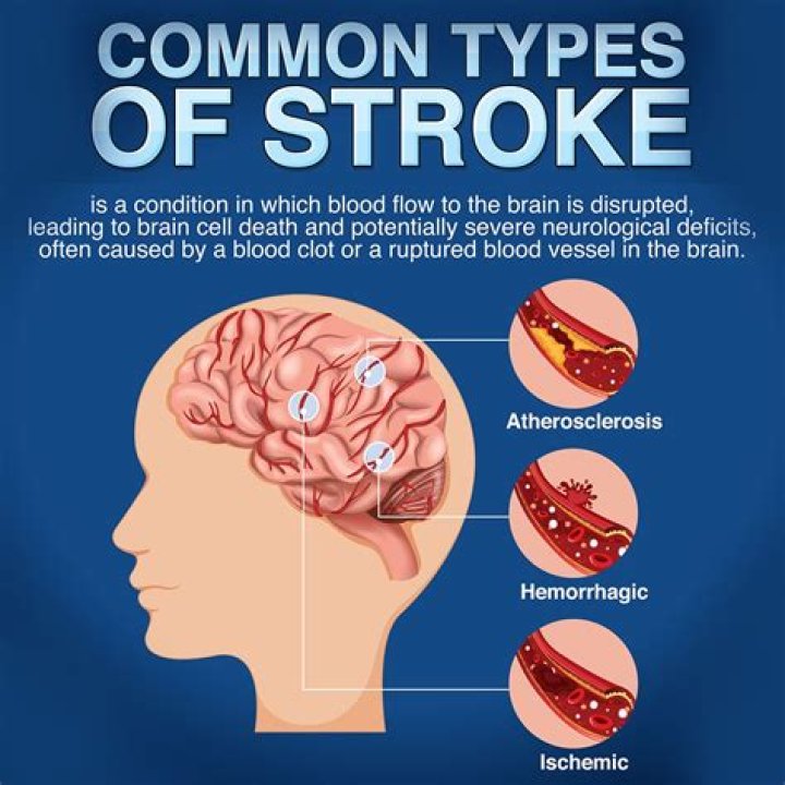Can cholecystitis cause a stroke?