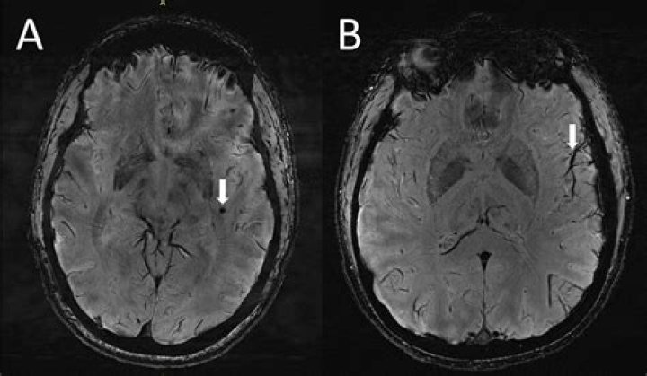 Can depression show up on an MRI?