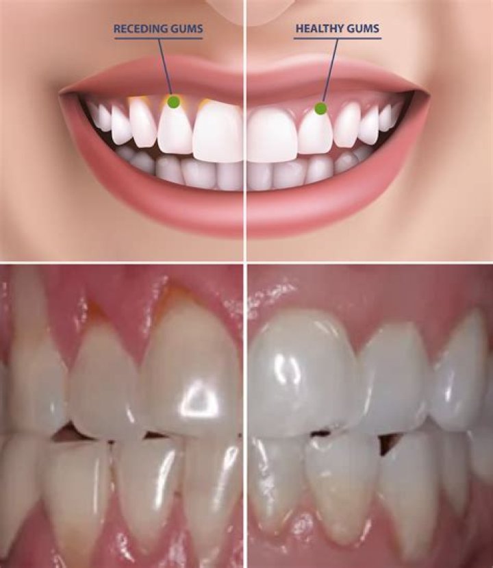 Can Oil pulling heal receding gums?