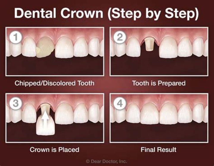 Can you have all your teeth crowned?
