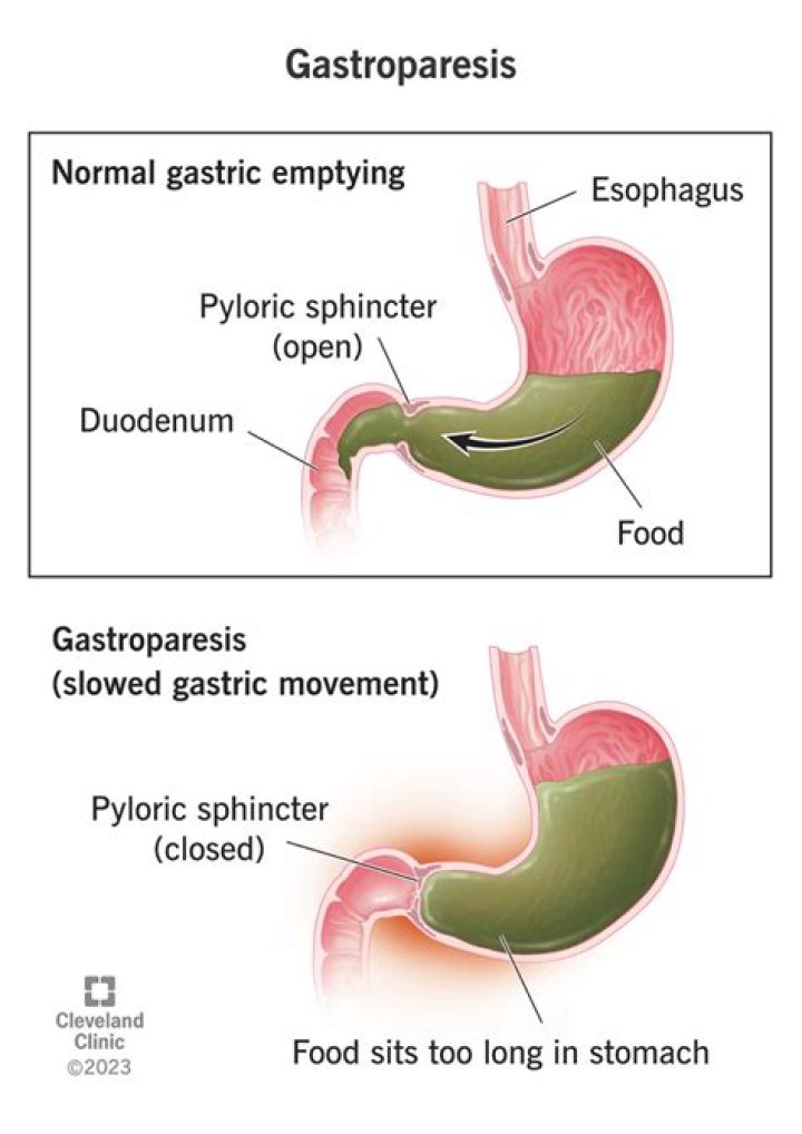 Can you reverse gastroparesis?
