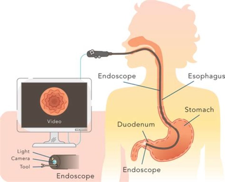 Can you see gastroparesis in an endoscopy?