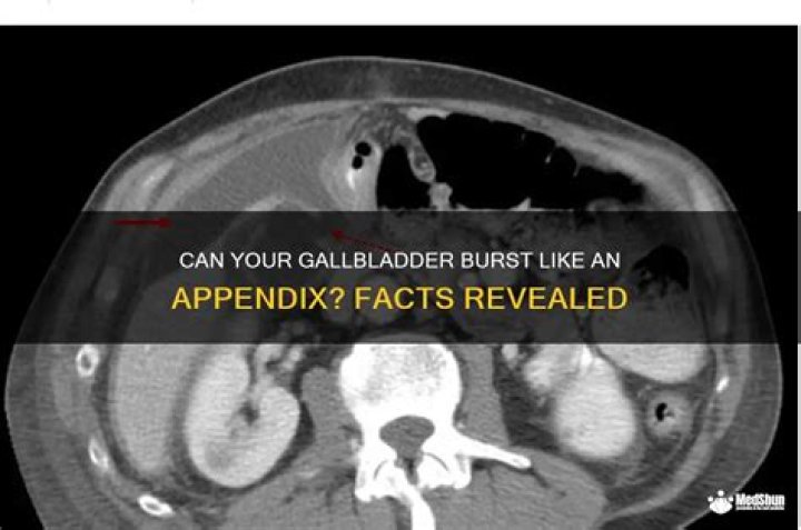 Can your gallbladder burst?