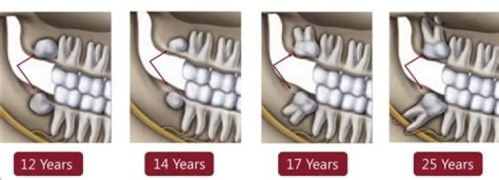 Can your wisdom teeth grow back?