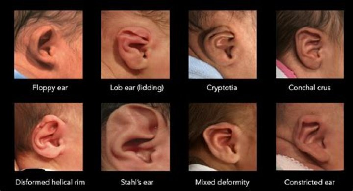 Do all babies ears stick out?