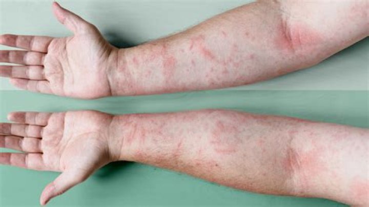 Do you keep eczema dry or moist?