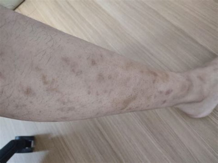 Does eczema leave scars?