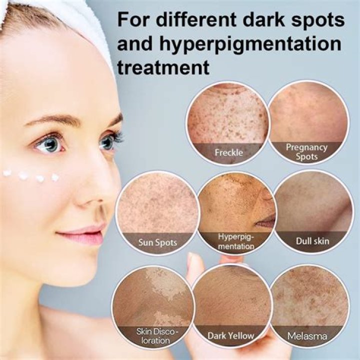 How can I reduce hyperpigmentation on my face?