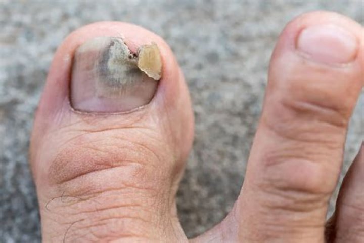 How do I stop picking my toenails?