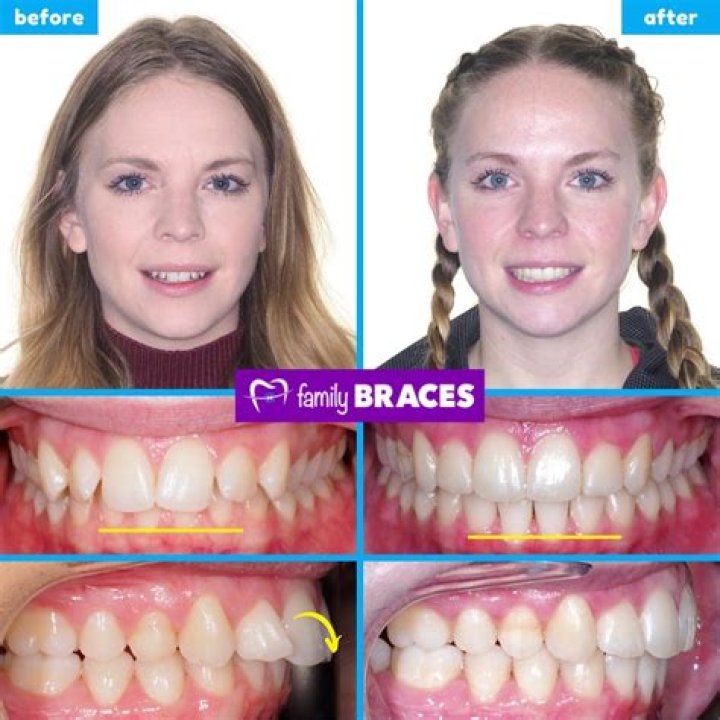How do you fix black teeth?