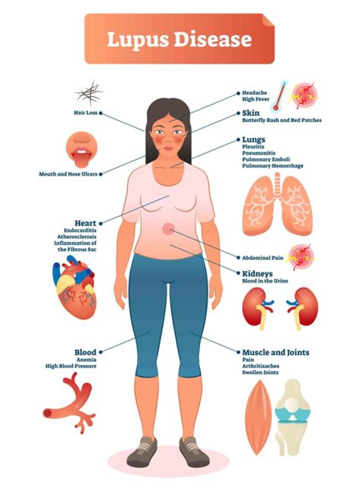 How does lupus affect your stomach?