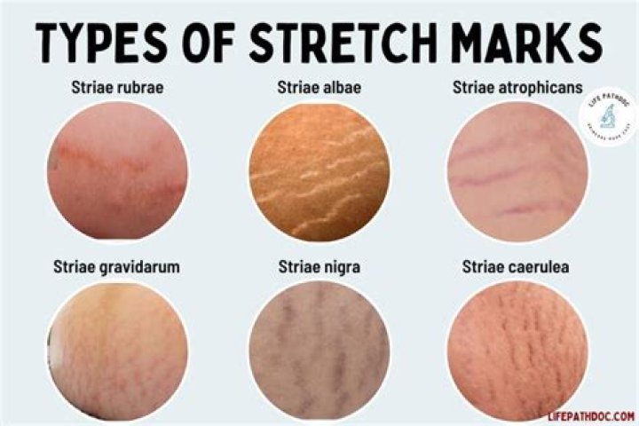 How long does it take for stretch marks to fade naturally?