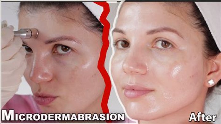 How often should microdermabrasion be done?