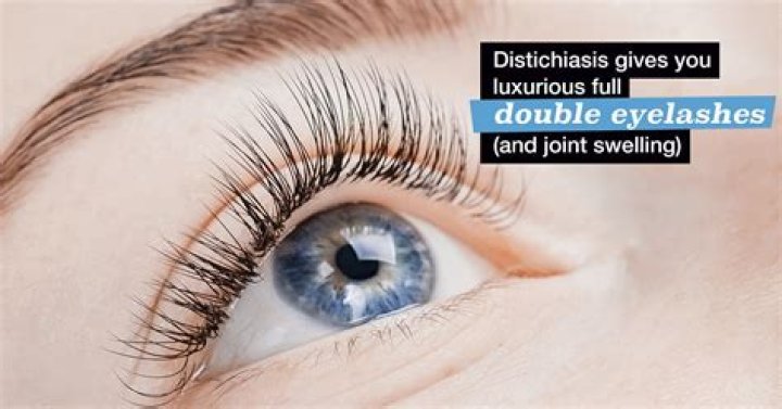 How rare is a double row of eyelashes?