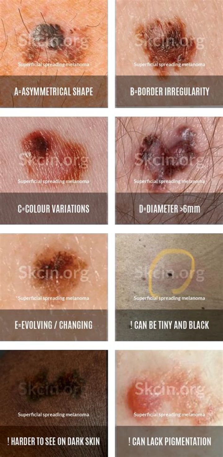 Is melanoma ever light brown?
