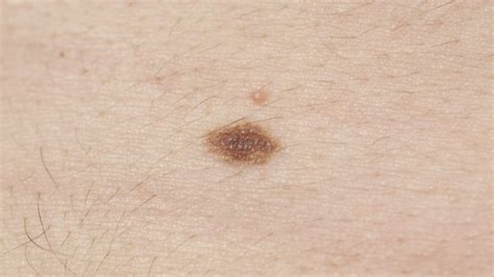Is melanoma smooth or rough?