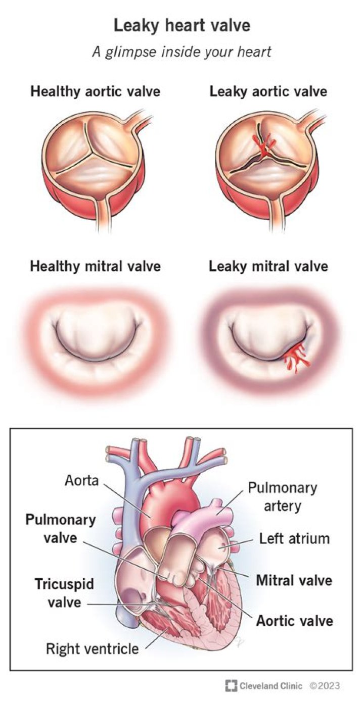 What are the symptoms of a leaking heart valve?