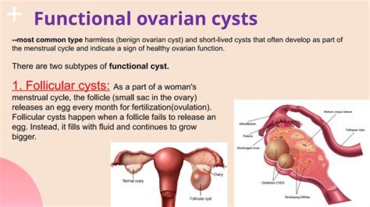 What are the symptoms of cysts on your ovaries?