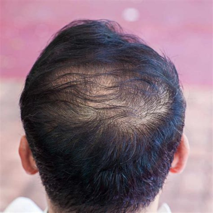 What can you do for thinning hair?