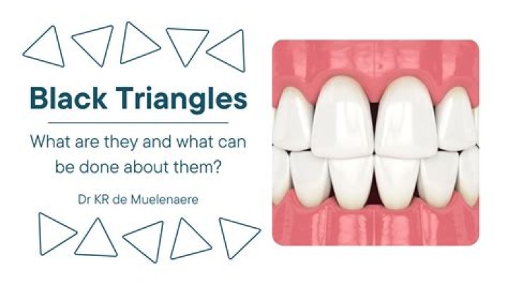 What did the black triangle mean?