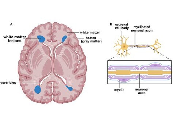 What do white matter lesions indicate?