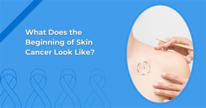 What does skin breakdown look like?