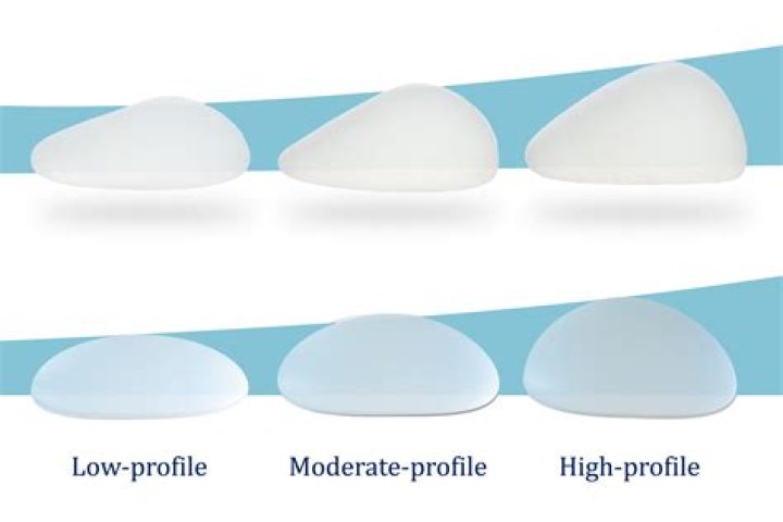 What holds breast implants in place?