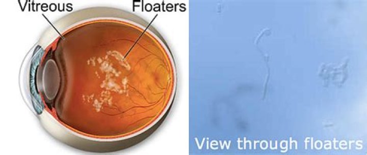 What is a shower of floaters?