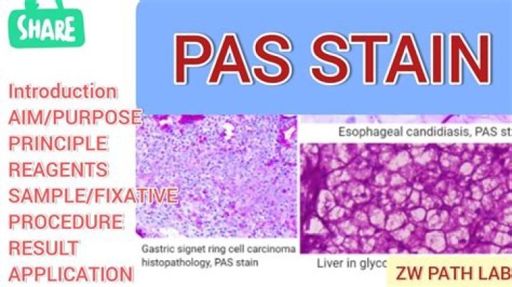What is PAS TB?