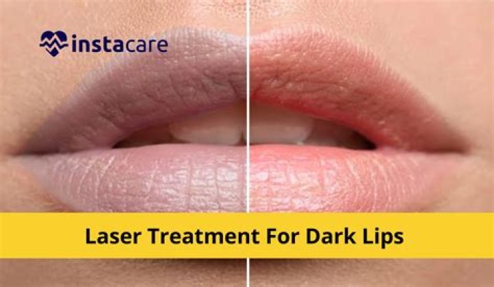 What is the best treatment for dark lips?