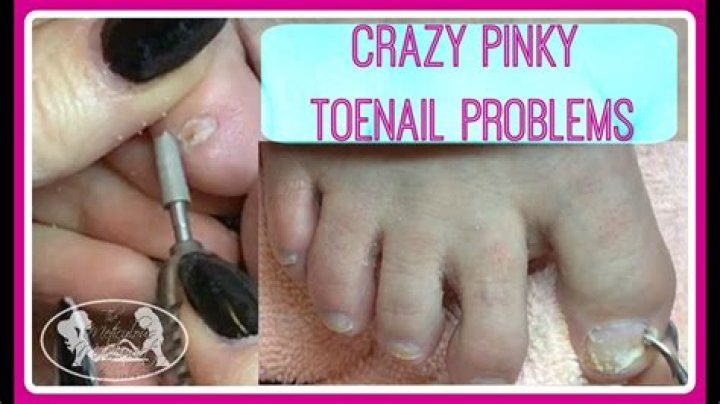 Why are pinky toenails small?