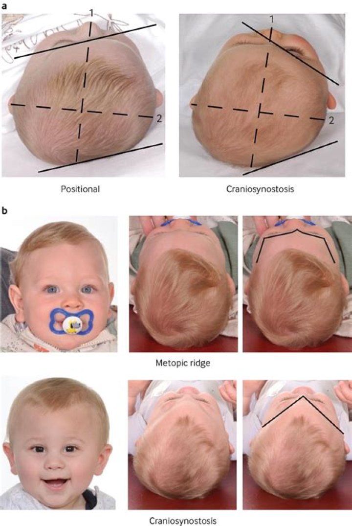 Why do babies get craniosynostosis?